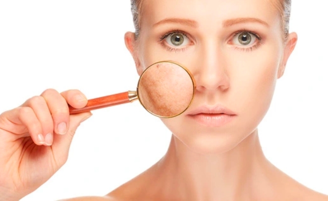 Hydroquinone trong mỹ phẩm thường có nồng độ từ 2% - 4%