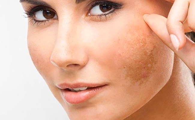 Vì sao da có hiện tượng sạm đen khi dùng Hydroquinone?